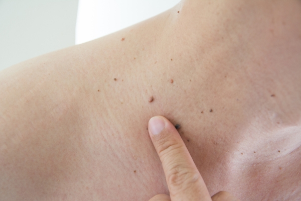 Mole Removal Treatment